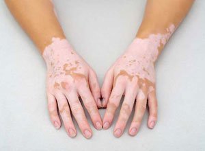 Sparsh Skin and Allergy Clinic in Mathura , Skin treatment in mathura, Skin clinic in mathura, laser treatment in mathura, Hair treatment in mathura, Best skin clinic in mathura